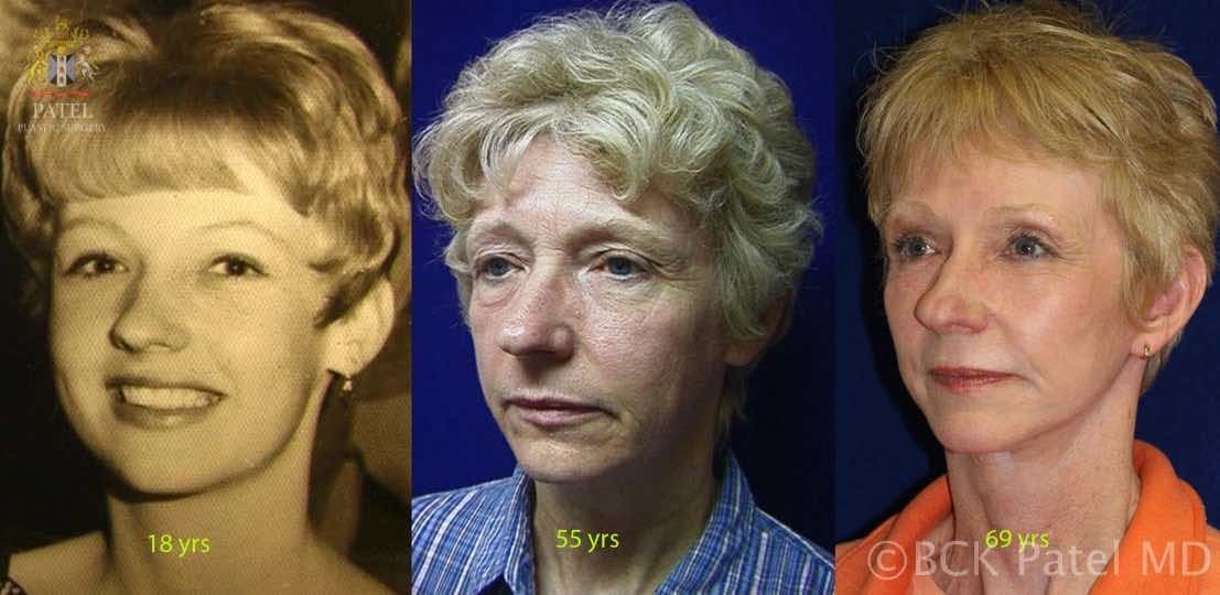 mid face aging