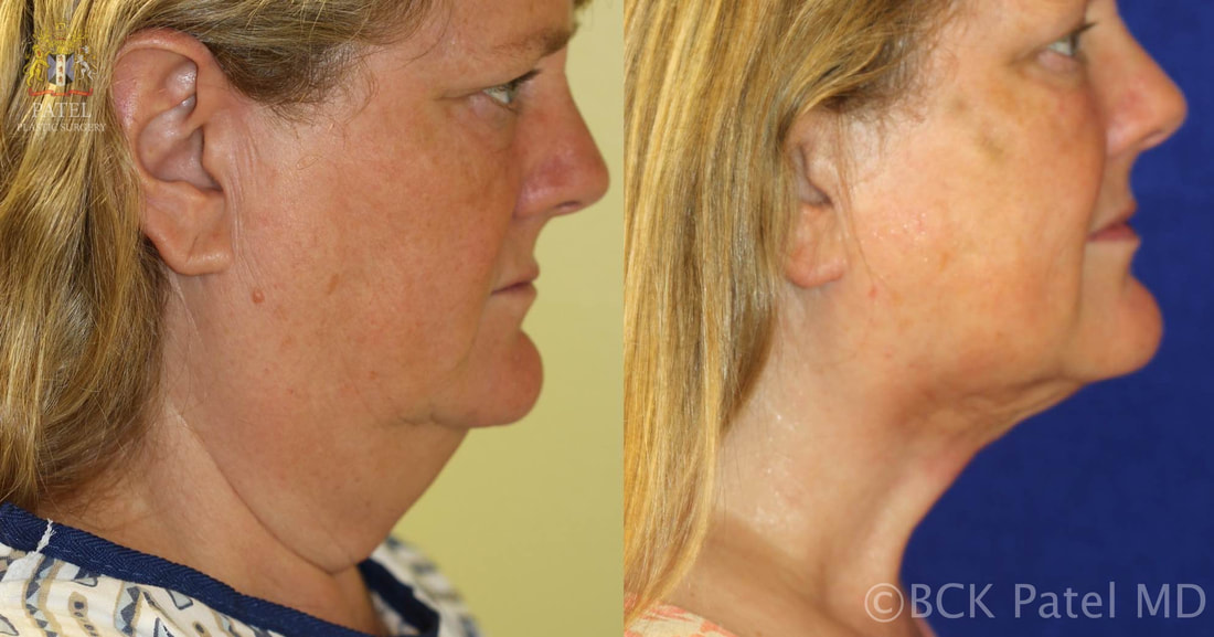 Neck and Chest Cosmetic Concerns St salt lake city