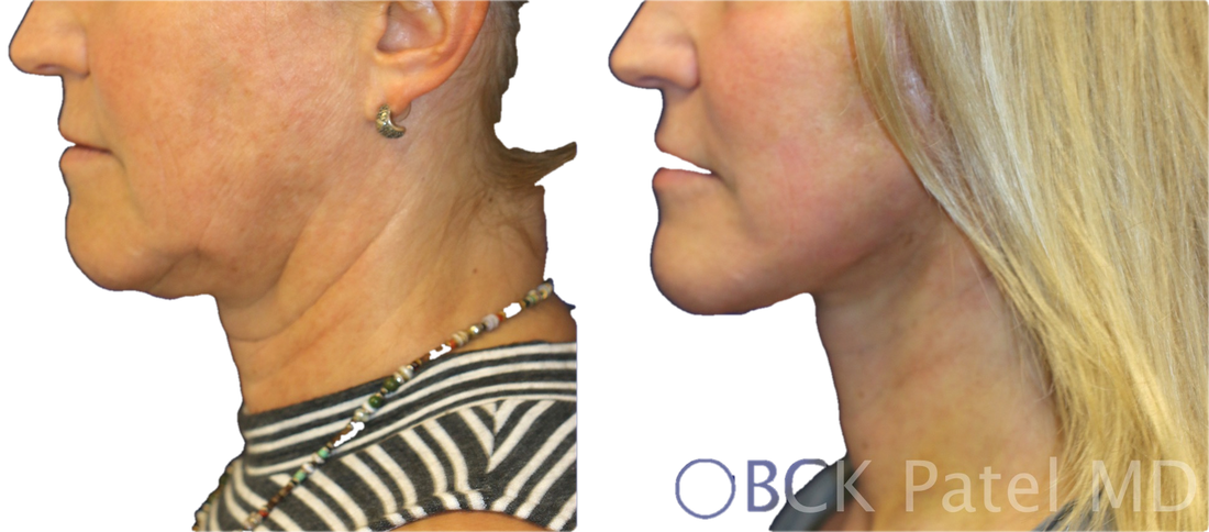 jawline aging treatment
