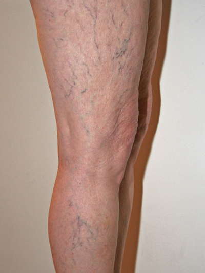 Leg veins surgery