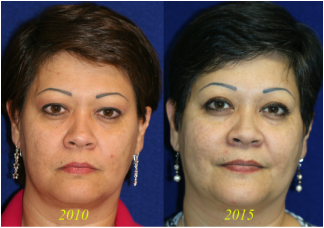 Blepharoplasty and also the long term results of upper and lower eyelid surgery