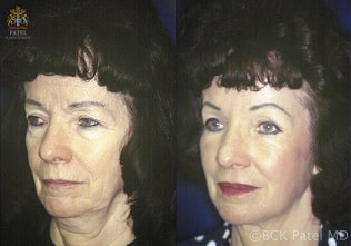 Best plastic surgeon Dr. Bhupendra C. K. Patel MD performing the best facelifts, blepharoplasty, lower blepharoplasty, laser, cheek lifts