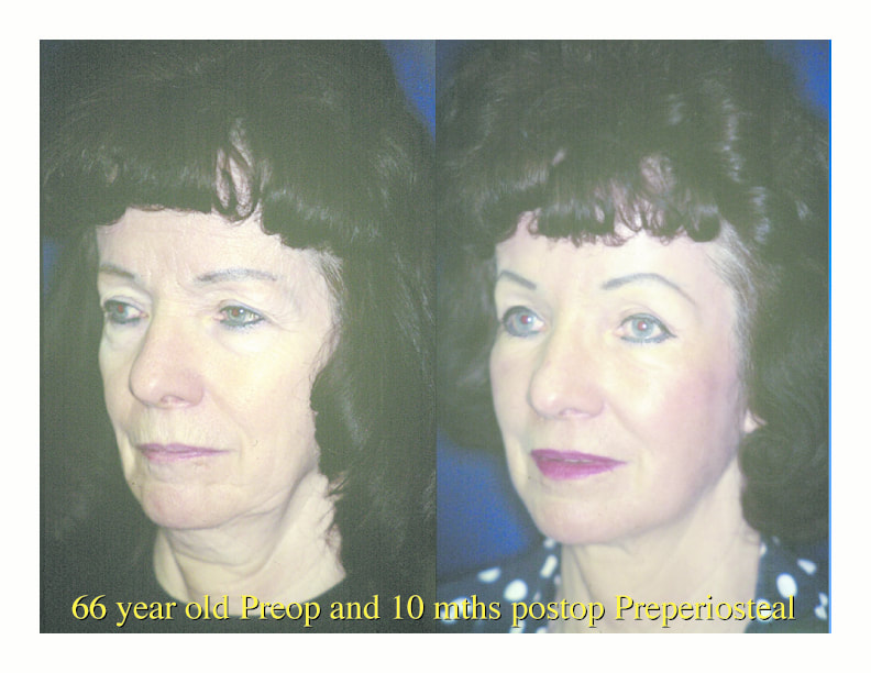 Browlifts and blepharoplasty combined with cheek lifts, fat grafts and laser of the skin gives beautiful long-lasting results