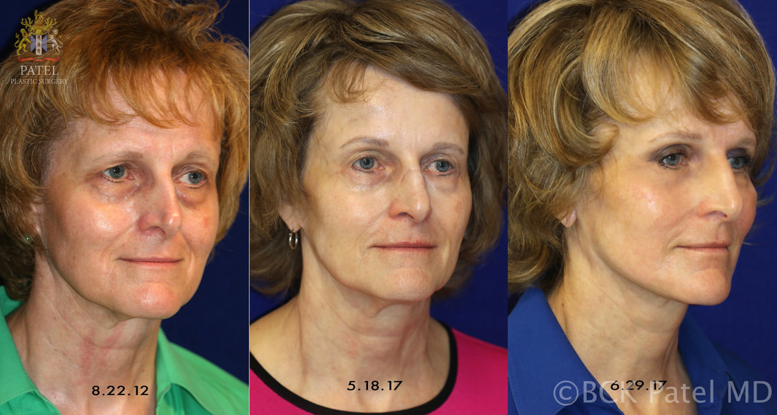A properly performed facelift together with browlifts and ptosis repair gives beautiful results