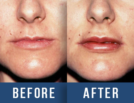 lips before after fillers