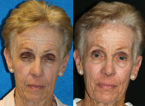 Brow ptosis and ptosis repair and facelift