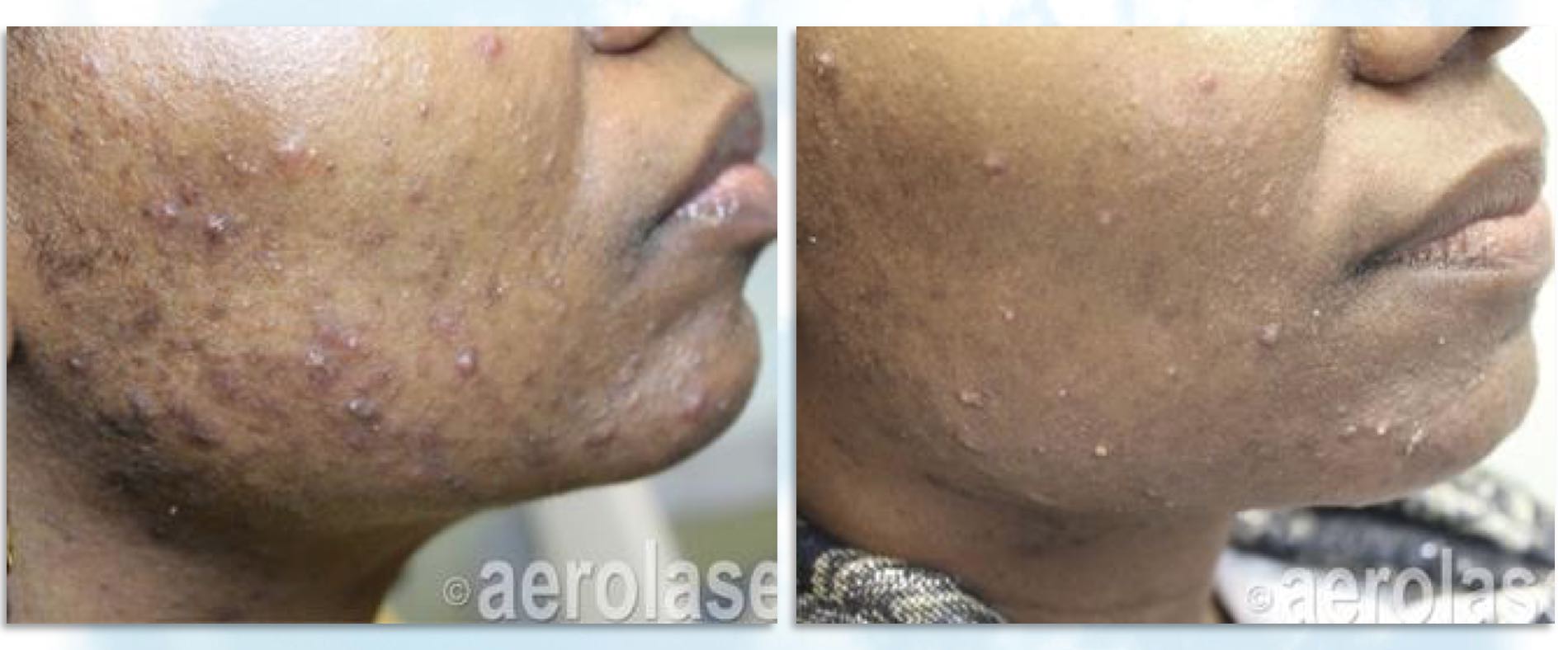 Cystic Acne in skin of color treatment Dr BCK Patel MD, FRCS Plastic Surgeon, Salt Lake City and St. George UtahPicture
