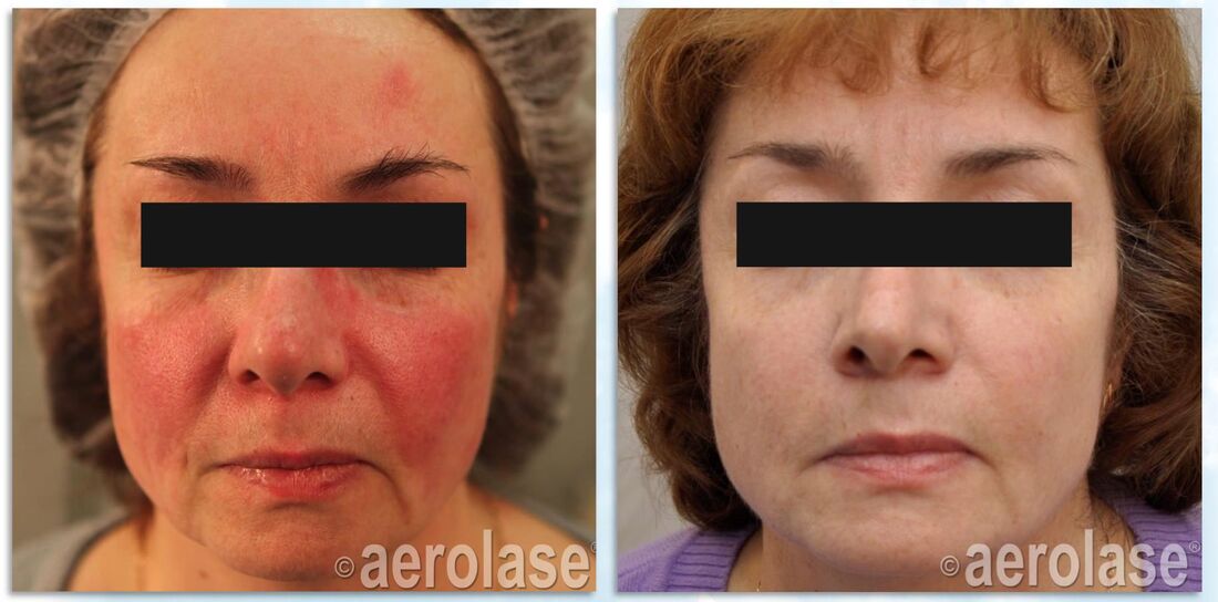 Acne Rosacea red face treatment veins Dr BCK Patel MD, FRCS with Aerolase Laser, Salt Lake City, and St. George, Utah Plastic SurgeonPicture