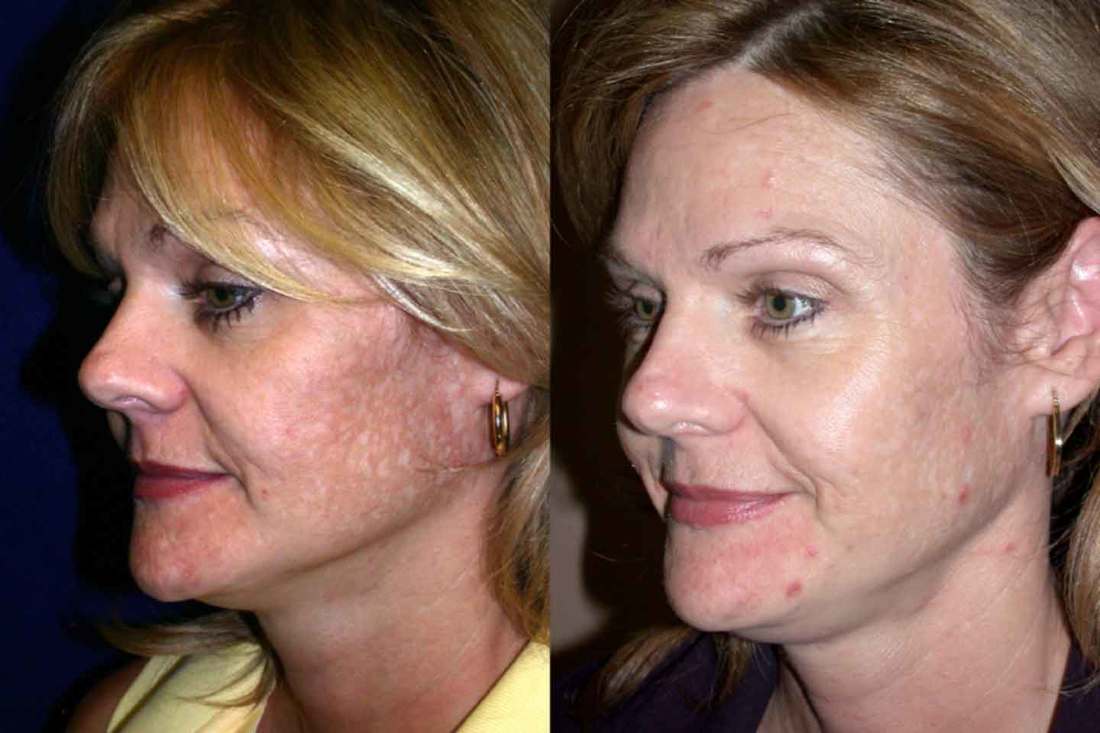 Acne scars treatment by Dr. Bhupendra C. K. Patel Md of Salt Lake City and Saint George, Utah