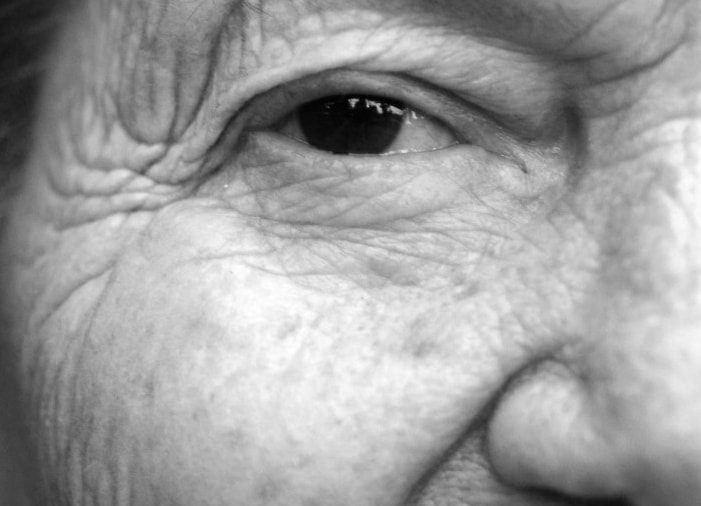 old eyelashes in an older person showing signs of aging by Dr BCK Patel MD