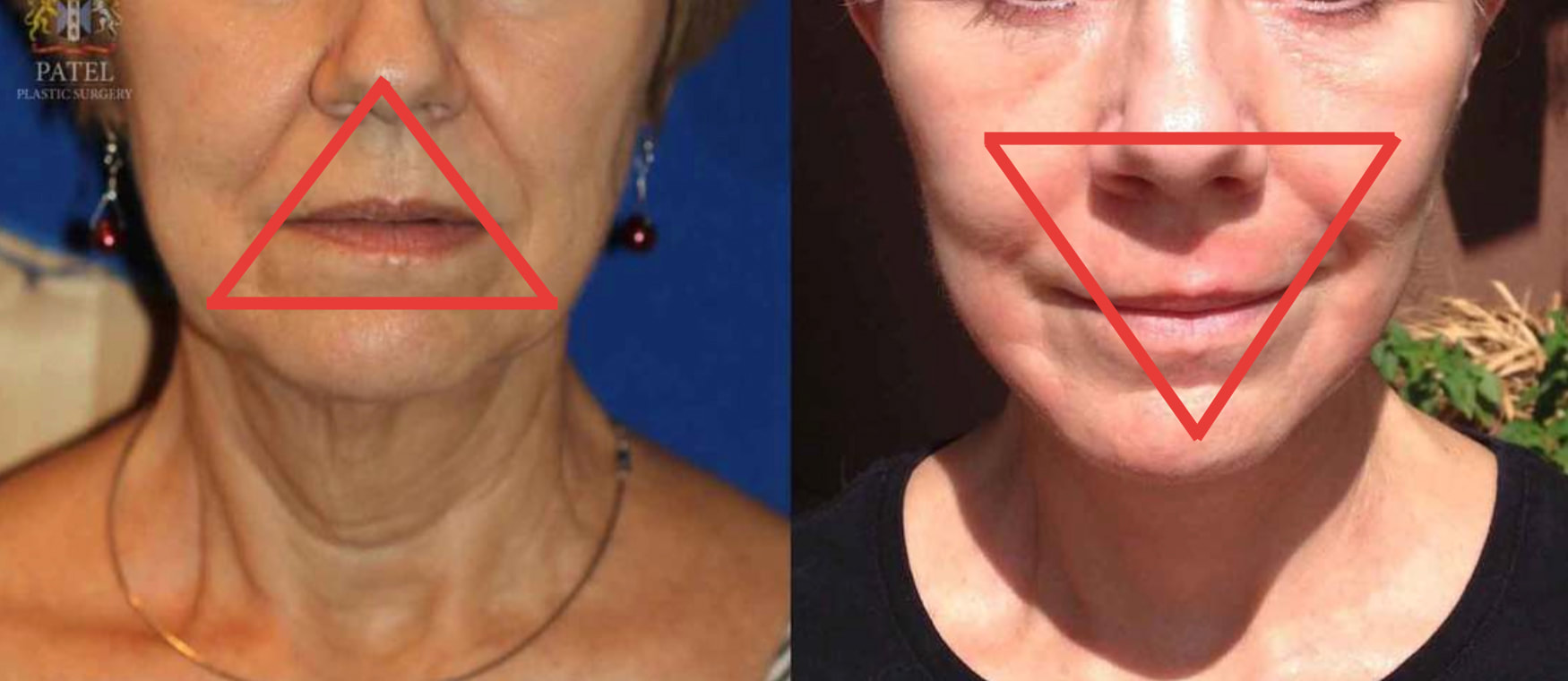 plastic surgery jowls before after pictures