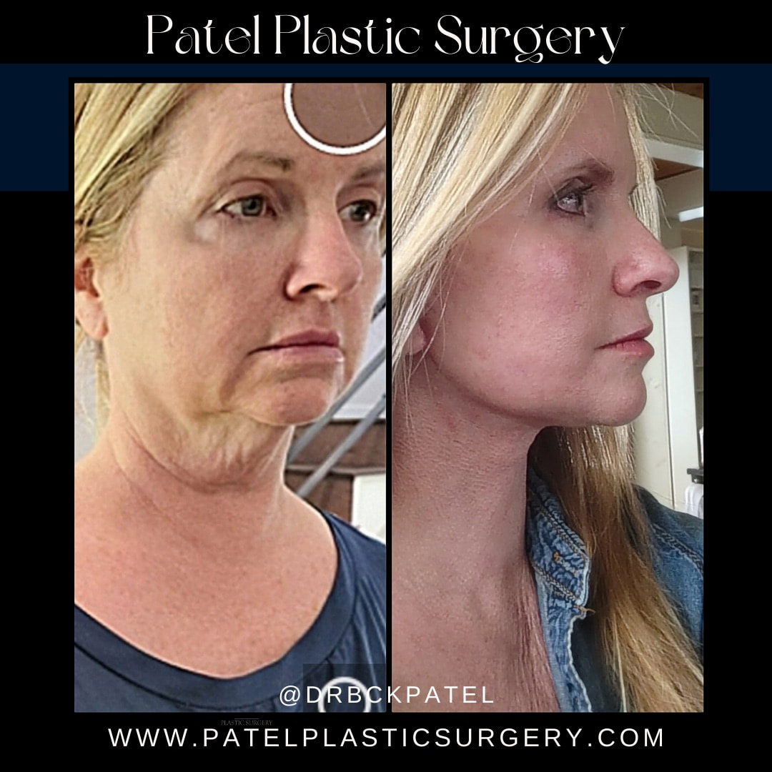 Before and after photographs after a facelift and neck lift by Dr. BCK Patel MD, FRCS using the patelfacelift technique