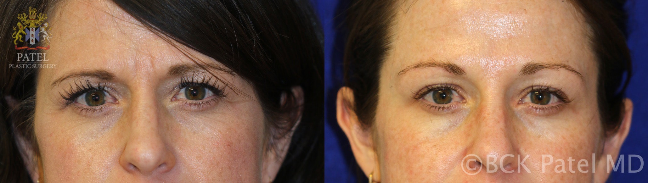 Botox injections to frown muscles, forehead lines and brows by Dr. BCK Patel MD, FRCS of Salt Lake City and St. George