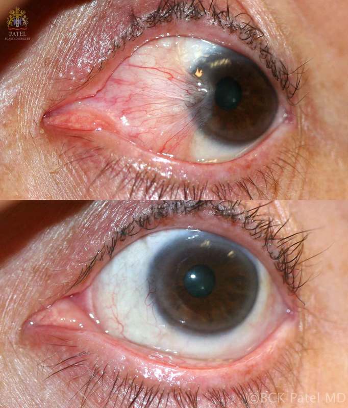 Extensive recurrent pterygium treated by Dr. Bhupendra C. K. Patel MD with resection and repair using a free conjunctival graft showing a beautiful result