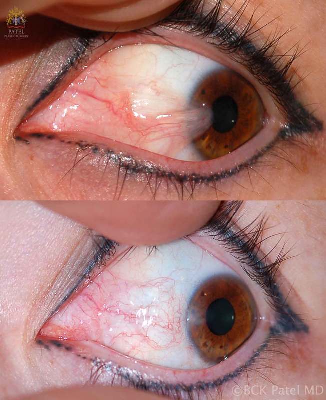 Before and after photograph of pterygium resection and free conjunctival graft by Dr. Bhupendra C. K. Patel MD