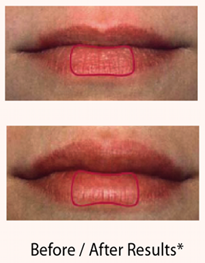 Lip fillers and laser to the skin improves the appearance of the lips and the mouth area. Fillers by Dr. Bhupendra C. K. Patel MD of Salt Lake City and Saint George, Utah
