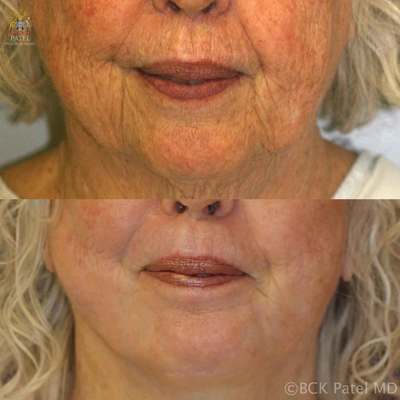 Lips before after laser surgery