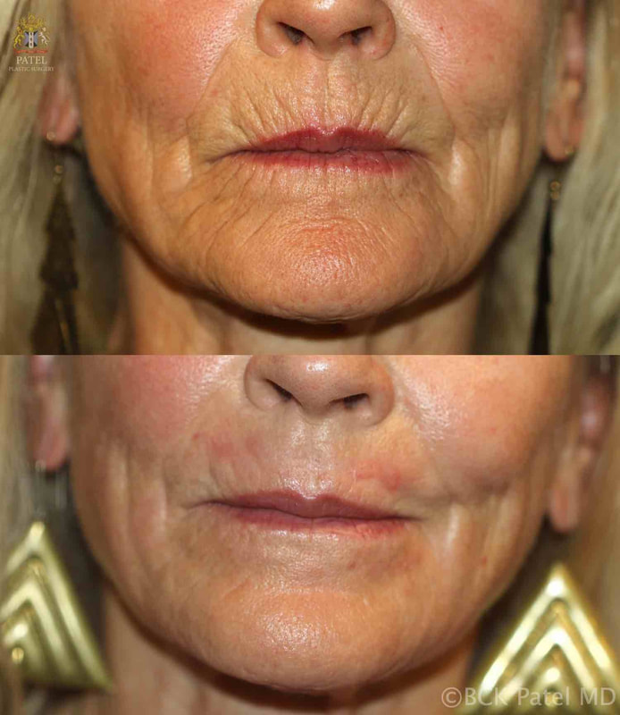 CO2 laser to lip lines by Dr. BCK Patel MD of Salt Lake City and St. George