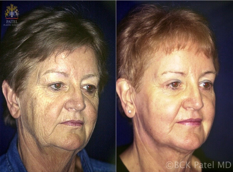 CO2 laser to the full face by Dr. Bhupendra C. K. Patel MD of Salt Lake City and Saint George. Patel Plastic Surgery