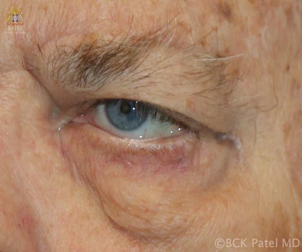 Brow ptosis, ptosis and lower lid laxity, retraction and cheek ptosis in myasthenia gravis: all the related findings need to be examined and assessed so as to choose the correct procedures in Myasthenia Gravis by Prof. BCK Patel MD, FRCS