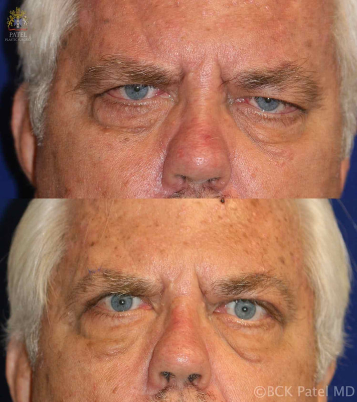 Correction of the frontalis muscle and brow ptosis as well as the lower lid laxity but conservative upper lid surgery allows the patient to see but to also close the eyelids and thereby protect the corneas by Prof. BCK Patel MD, FRCS