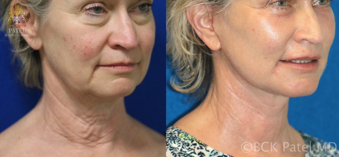 Advanced deep plane Facelift and neck lift together with use of nano fat grafts and lasers giving beautiful facelift and neck lift results by Dr. BCK Patel MD, FRCS of Salt Lake City and St. George, Utah showing before and after results of facelift and neck lift by Dr BCK Patel 