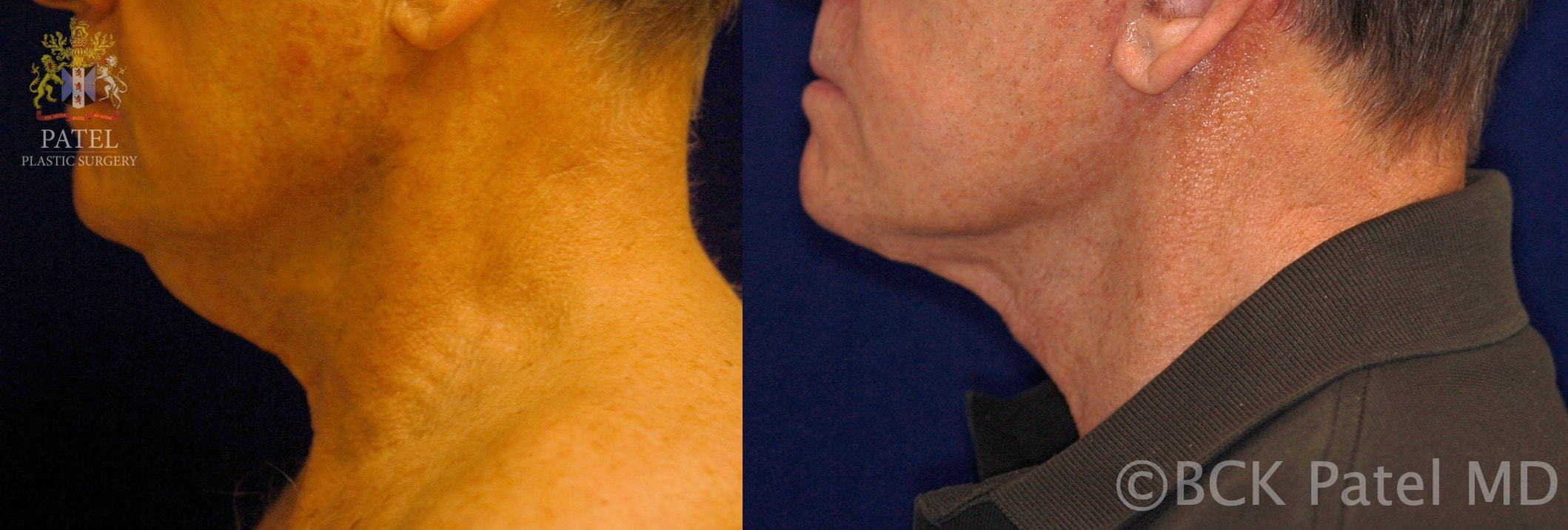 Facelift and necklift by Dr. BCK Patel MD, FRCS