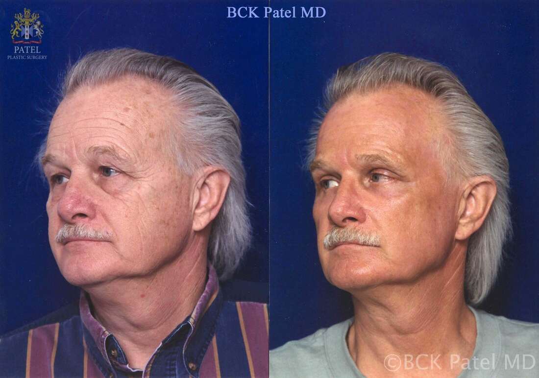 Browlifts, upper and lower blepharoplasty, fat grafts and CO2 laser in a male showing marked cosmetic improvement of the face by Dr. Bhupendra C. K. Patel MD of Salt Lake City, and Saint George, Utah