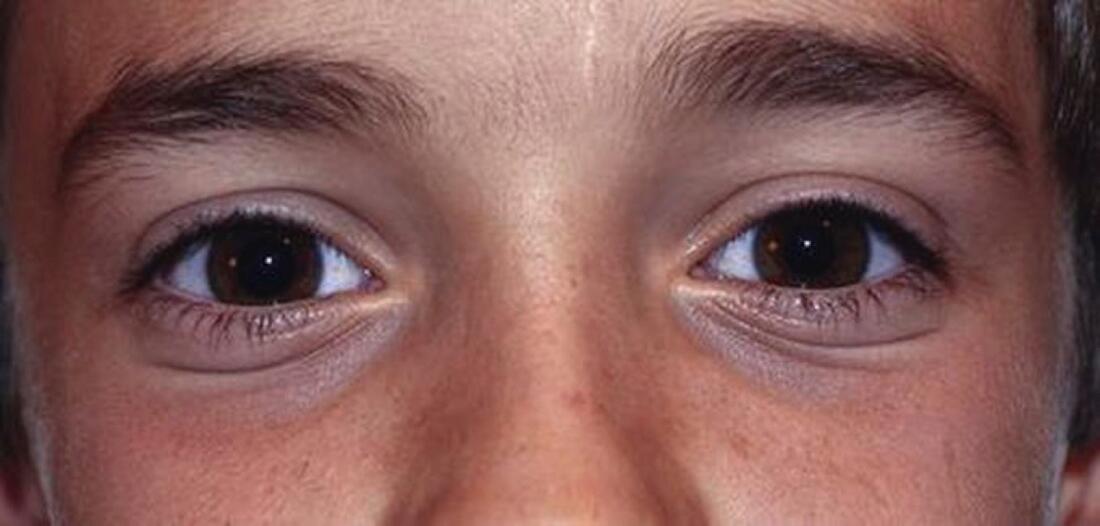 Dennie-Morgan lines in adolescence with skin thickening and parallel creases and folds dr BCK Patel MDPicture