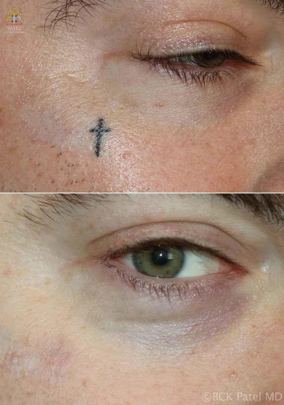 Laser tatto removal by Dr. Bhupendra Patel MD