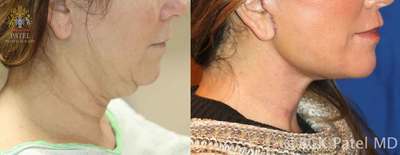 neck patel plastic surgery