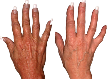 laser hand treatment