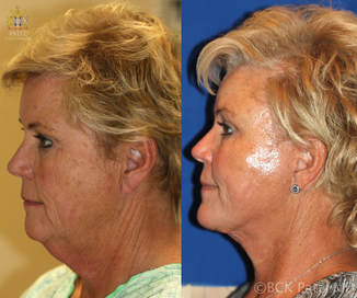 A facelift and necklift together with the use of lasers and fat grafts gives a nice jawline and neck