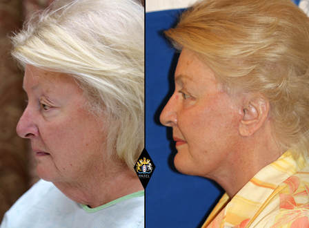 aging chin plastic surgery treatment before after photos