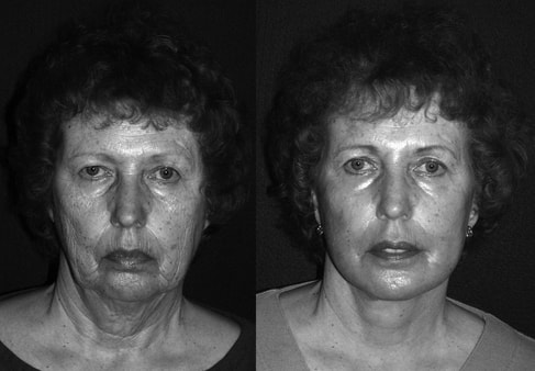 A facelift combined with lasers, fat graft and tissue repositioning gives an improvement in the skin, facial tissues and the jawline and neck