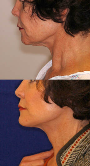 aging neck treatment