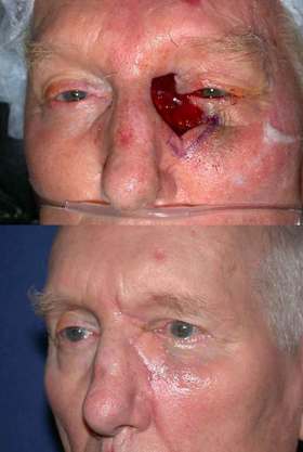 Basal cell carcinoma defects on the face repaired using advanced flaps and grafts by Dr. BCK Patel MD, FRCS of Salt Lake City and St. George, Utah.