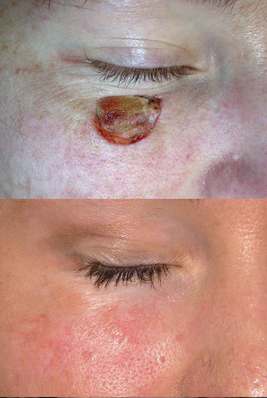Basal cell carcinoma defects on the face repaired using advanced flaps and grafts by Dr. BCK Patel MD, FRCS of Salt Lake City and St. George, Utah.