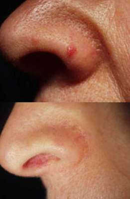 Nose and face vascular and pigmented moles removed using lasers Mole removal performed by Dr. BCK Patel MD, FRCS of Salt Lake City and St. George, Utah. Beautiful results of mole removal and pigment reduction using advanced lasers by Dr. BCK Patel MD