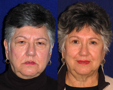Browlifts combined with upper and lower blepharoplasty judiciously performed makes the face look slimmer!