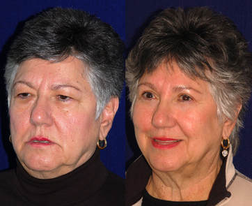 Browlifts, when combined with upper and lower blepharoplasty give, essentially, a top-half facelift!