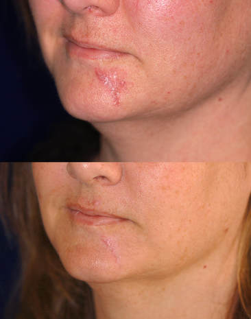 scar removal surgery before and after
