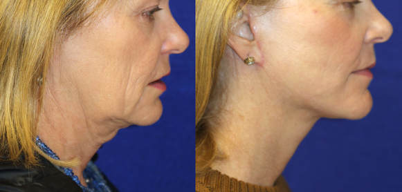 Advanced facelift and necklift pays attention to the jawline, neck and the submental fullness and laxity. A beautifully performed facelift is seen here