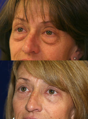 Aging lower eyelids come in many forms: they don't just have bags. Dark circles, grooves, laxity, wrinkles, crows' feet, etc have to be assessed and addressed