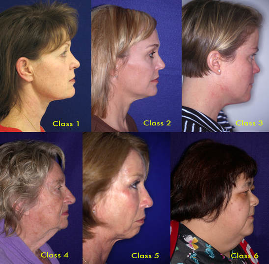 aging neck plastic surgery