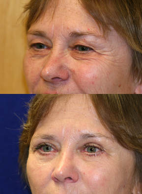 It is common to perform upper and lower blepharoplasty together, sometimes with browlifts to allow us to create a three-dimensional improvement in the middle part of the face