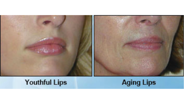 lips surgery before after