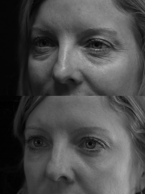 In other patients, dark circles are combined with loose lower eyelid skin and wrinkles and only a little fat. Here, repositioning fat, use of lasers, tightening of muscles and judicious peeling of the skin is needed to give beautiful results