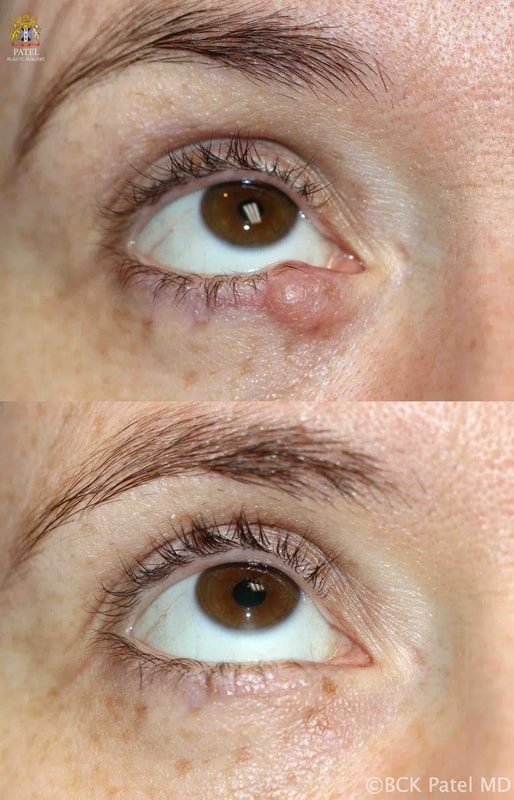 Lesion on the lower eyelid which was cystic was treated neither with lasers nor surgical resection. Proper drainage and injection with anti-scarring drugs gave us an excellent result. Surgery by Dr. BCK Patel MD, FRCS FRCS of Salt Lake City and St. George, Utah. Beautiful cosmetic mole removal