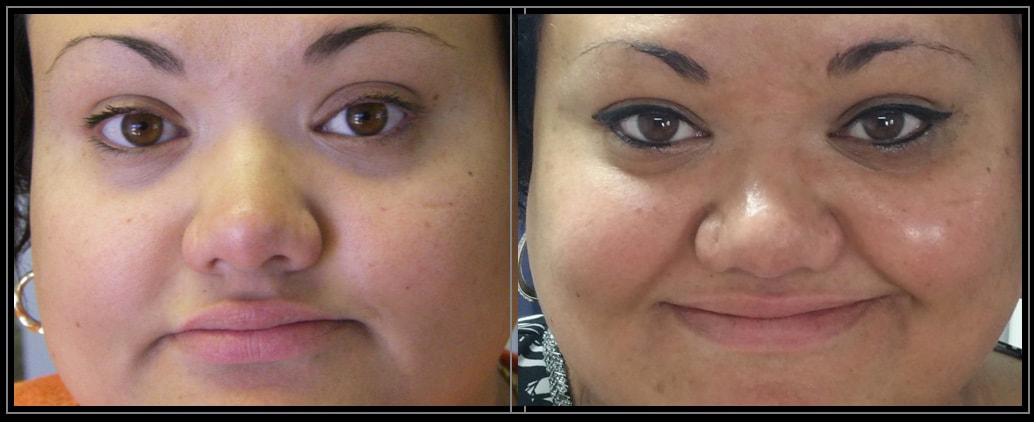 Photos show permanent eyeliner makeup tattoo. BCK Patel MD, FRCS Professor Bhupendra C. K. Patel MD, FRCS